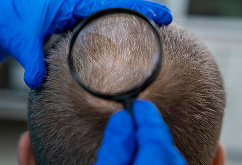 9 Recommendations to Pay Attention to After PRP Hair Treatment