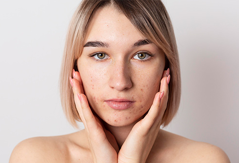 What Are the Most Effective Methods to Eliminate Acne Scars?