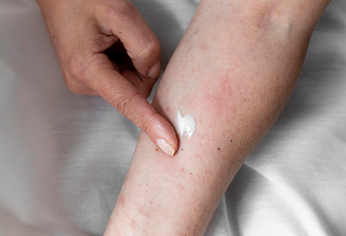 What Are Warts? What Are Wart Treatment Methods?