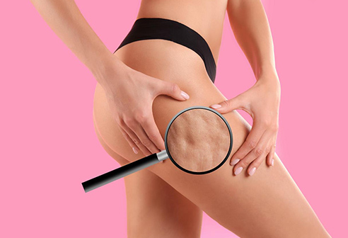 What is Cellulite and How is it Treated?