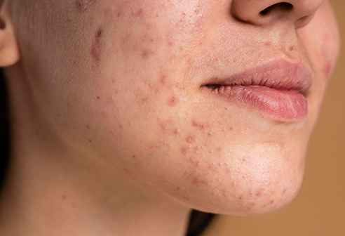 What is the Reason for Persistent Acne?