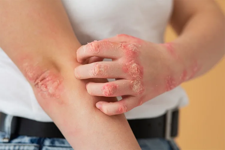 Is Morpheus 8 Skin Rejuvenation Treatment Applied to Psoriasis Patients?